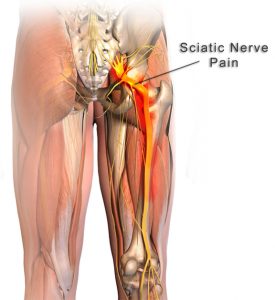 sciatic-nerve-and-nerve-pain-275×300
